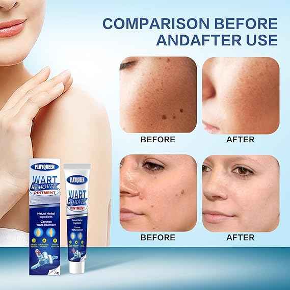 Wart Remover Ointment